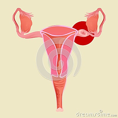 Illustration of uterus with ectopic pregnancy. gynecology Vector Illustration