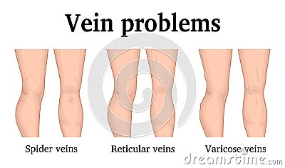 Illustration of vein problems Vector Illustration