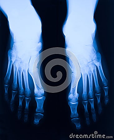 Foot xray Stock Photo