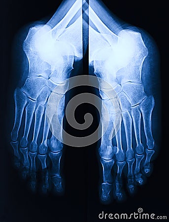 Foot xray Stock Photo