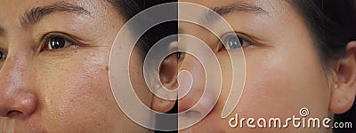 Image before and after treatment rejuvenation surgery on face asian woman concept. Closeup wrinkles dark spots pigmentation . Stock Photo