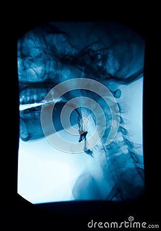 The image of x-ray upper gastrointestinal (UGI), Esophagram. Stock Photo