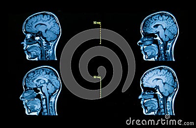 Images from a computerized tomography of the brain Stock Photo