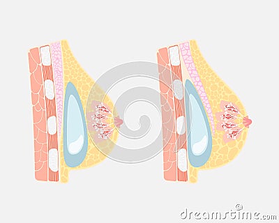 Implant placement silicone surgery human breast under and over pectoralis muscle, mammary nipple, internal organs anatomy Vector Illustration