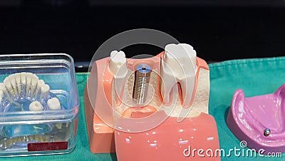 The implant substructure teeth model Stock Photo