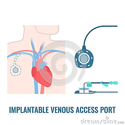 Implantable venous access port on male body Vector Illustration