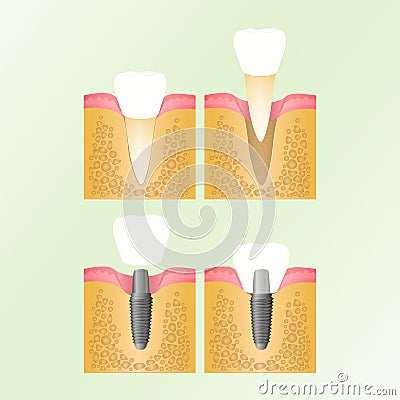 Implantation of the tooth Vector Illustration