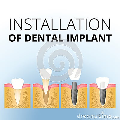 Implantation of the tooth Vector Illustration