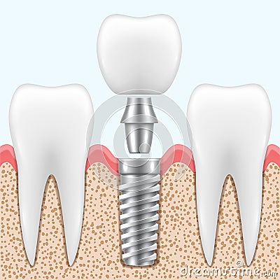 Implantation of tooth process in realistic style. Stomatological restoration, rehabilitation on implant. Vector Illustration