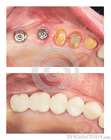 Before and after - implants and crowns Stock Photo