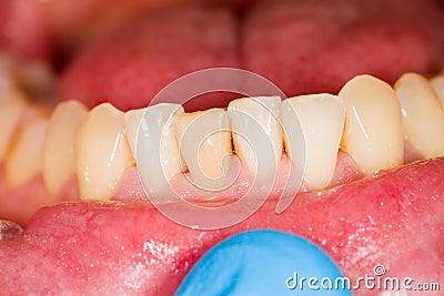 Incisors as Subject of Dental Photography Stock Photo