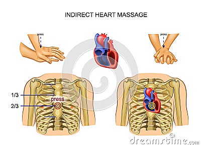 Indirect heart massage Vector Illustration