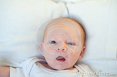 Infant acne, allergy, atopic dermatitis Stock Photo