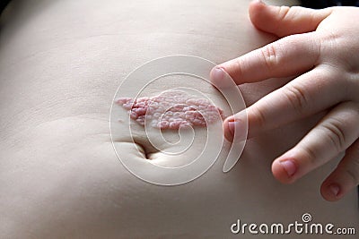 Capillary hemangioma regression. Red birthmark on the baby`s belly after treatment Stock Photo