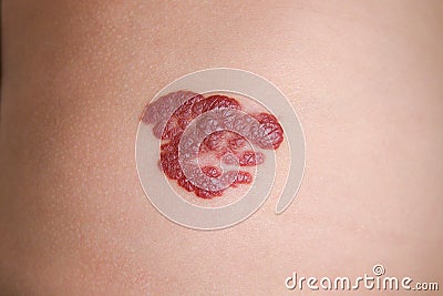 Infantile Hemangioma red birthmark on the baby`s belly Stock Photo