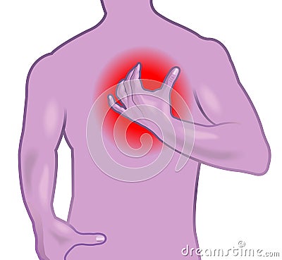 Infarct medical illustration Vector Illustration