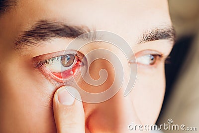 Infected sty barley purulent eye. Man pulls down lower eyelid showing inflammation pus caused by Staphylococcus Stock Photo