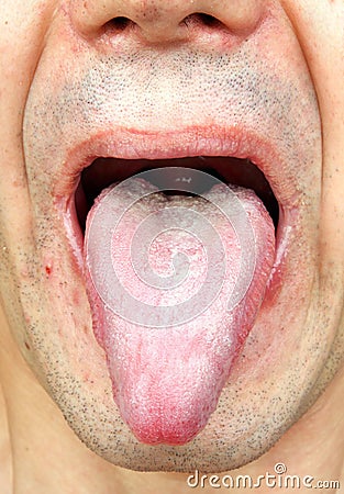 Infection tongue Stock Photo