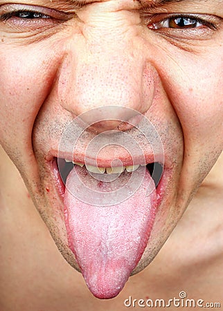 Infection tongue Stock Photo