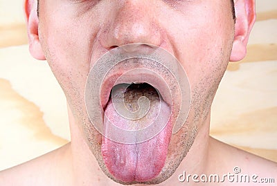 Infection tongue Stock Photo