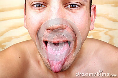 Infection tongue Stock Photo