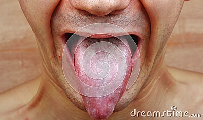 Infection tongue Stock Photo