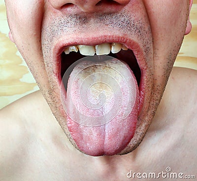 Infection tongue Stock Photo