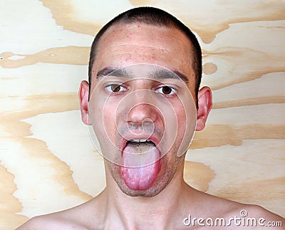 Infection tongue Stock Photo