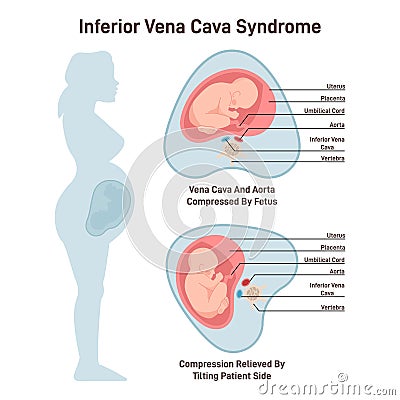 Inferior vena cava syndrome. Pregnant woman has a compression Vector Illustration