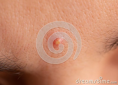 Inflamed acne on the skin of the face Stock Photo