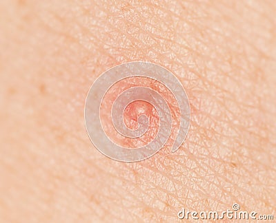 Inflamed acne on the skin Stock Photo