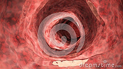 An inflamed colon Cartoon Illustration