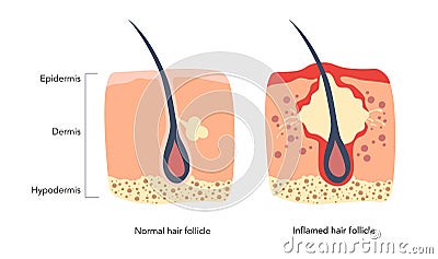 Inflamed hair follicle medical scheme zoomed Vector Illustration