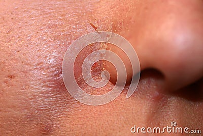 Inflamed skin on the face. Acne. Pimples on the skin. Scars and peeling. Stock Photo