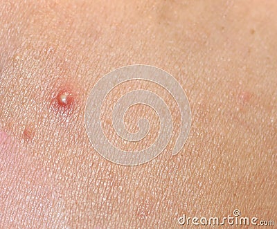 Inflamed skin on the face. Acne. Pimples on the skin. Scars and peeling. Stock Photo