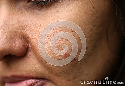 Inflamed skin on the face. Acne. Pimples on the skin. Scars and peeling. Stock Photo