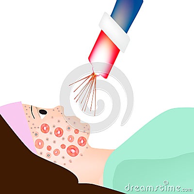 Inflamed Skin with scars, blackheads and pimples. Treatment of acne on the skin of the face with a laser. Infographics Vector Illustration