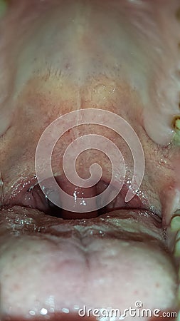 Inflamed uvula Stock Photo