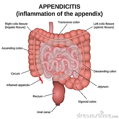 Inflammation of the appendix Vector Illustration