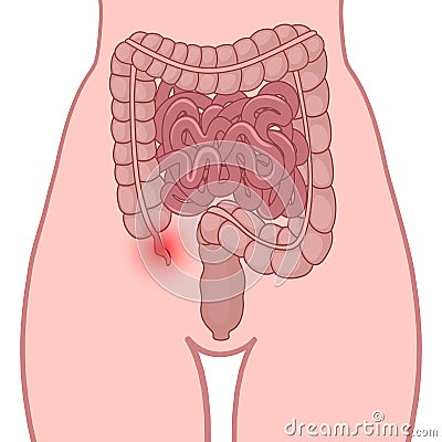 Inflammation of the appendix Vector Illustration