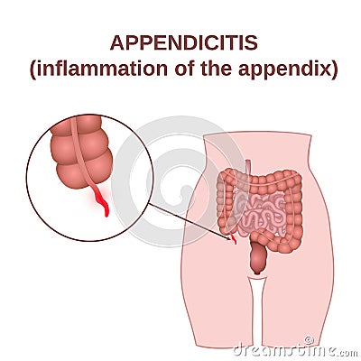 Inflammation of the appendix Vector Illustration