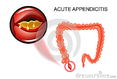 The inflammation of the Appendix Vector Illustration