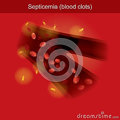 Septicemia infographic 3d Illustration. Vector Illustration