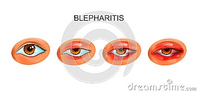 Inflammation of the eyelids. blepharitis Vector Illustration