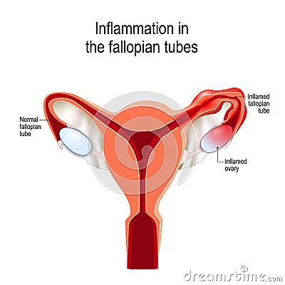 Fallopian tubes Inflammation Vector Illustration