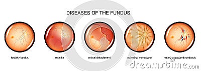 Inflammation of the fundus, retinal detachment Vector Illustration