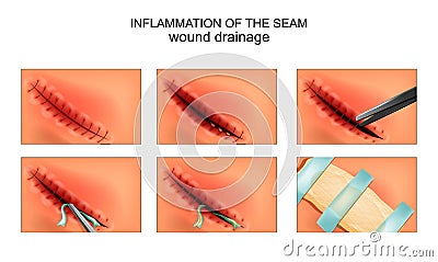 Inflammation of the surgical site. wound drainage Vector Illustration