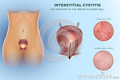 Inflammation of the urinary bladder Vector Illustration