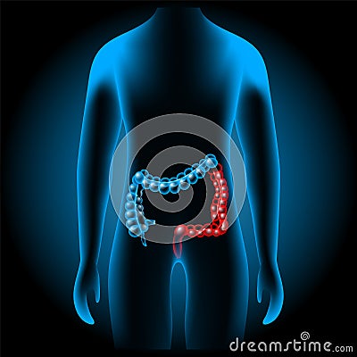 Inflammatory bowel disease Vector Illustration