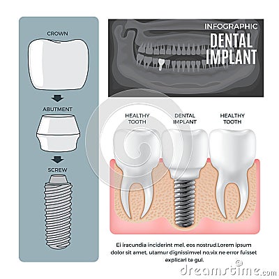 Infographic Dental Implant Structure Info Poster Vector Illustration